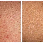 strawberrry-legs-skin-care-